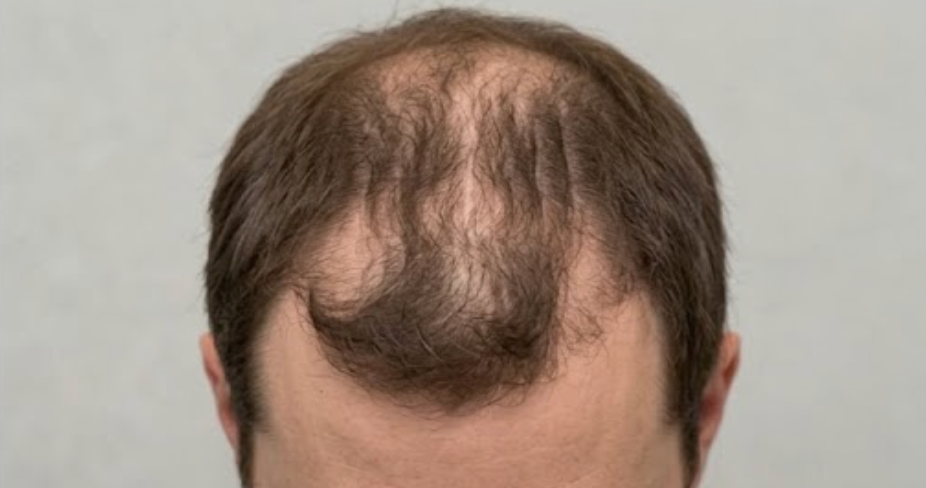 Poor Hair Growth or Patchy Results