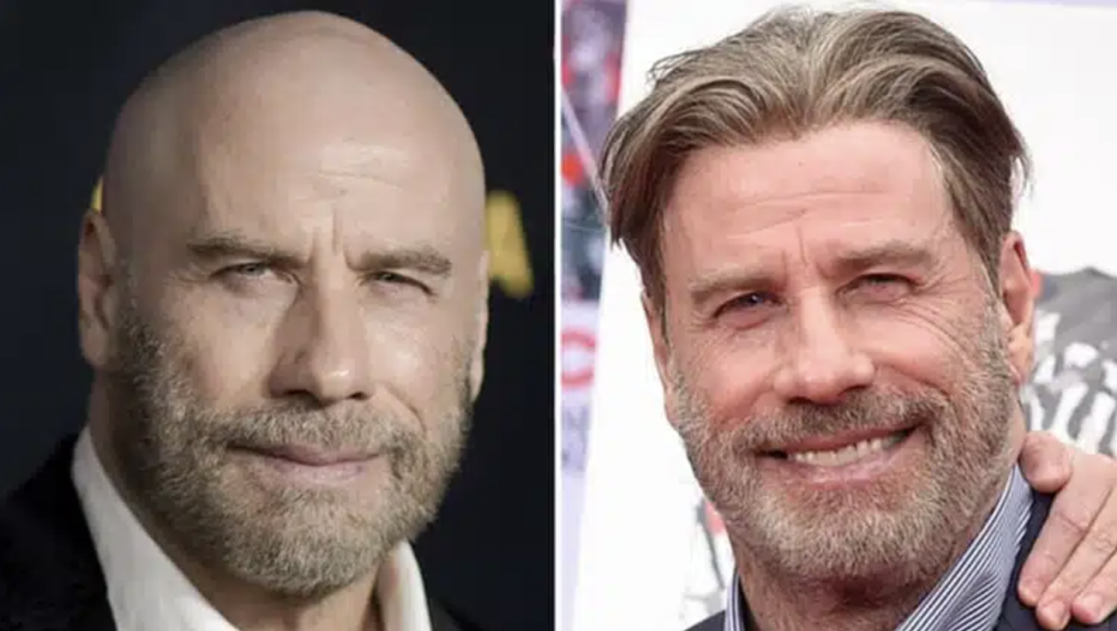 Celebrity Hair Transplant Gone Wrong