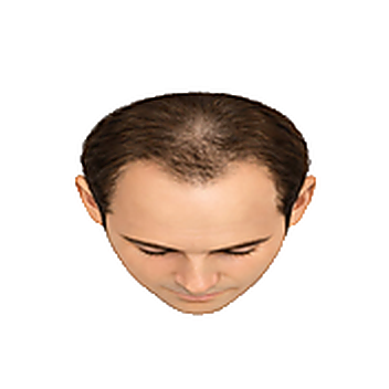 Stage 3