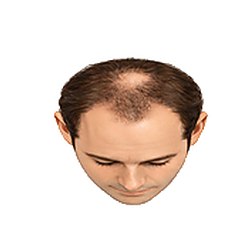 Stage 3V