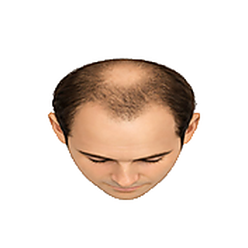 Stage 4