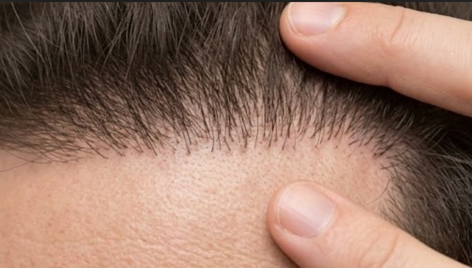 Unnatural Hairline