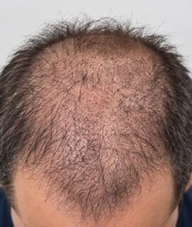 Hair Transplant Progress Timeline